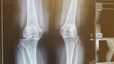pre-surgery knees